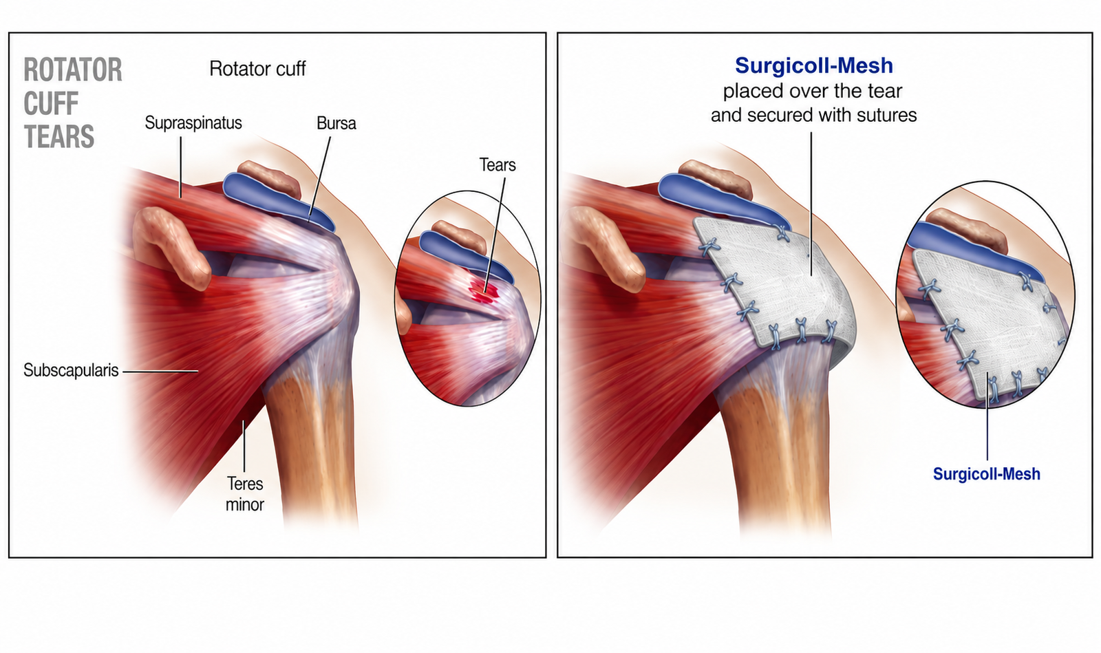 Rotator cuff tears diagram showing supraspinatus, bursa, subscapularis and teres minor with Surgicoll-Mesh secured
